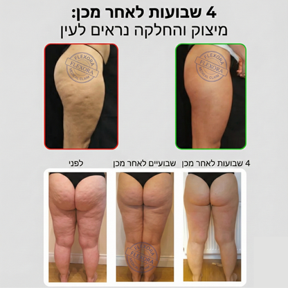 טייץ עם כיסים בעל אפקט משולש נגד צלוליט, ורידים וליפדמה FLEXORA